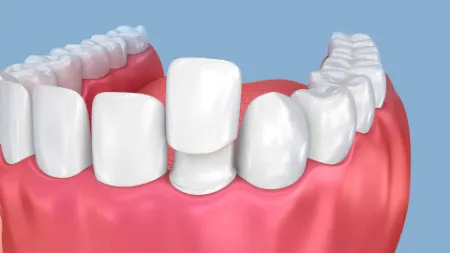 افتادن روکش دندان, علت افتادن روکش دندان, افتادن روکش دندان یک مسئله رایج