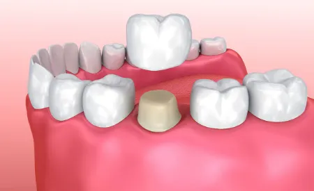 افتادن روکش دندان, علت افتادن روکش دندان, عوارض افتادن روکش دندان