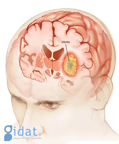 علائم تومور مغزی گلیوما, انواع تومور مغزی گلیوما