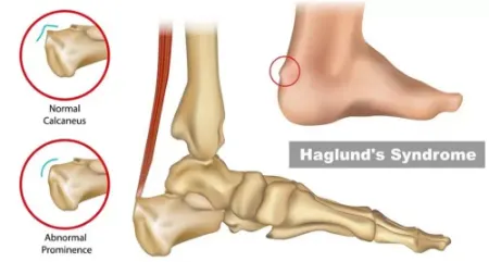 بیماری هاگلند؛ علت برآمدگی پشت پاشنه پا و روش های درمان آن