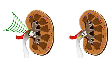 لیتوتریپسی, انواع لیتوتریپسی,خرد کردن سنگ ها با روش لیتوتریپسی