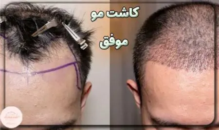نشانه‌های موفقیت‌آمیز بودن کاشت مو در کلینیک آفرینش چیست؟