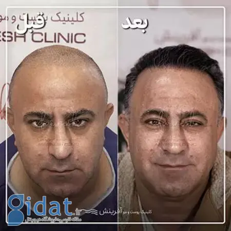 مهمترین نشانه های کاشت مو موفق