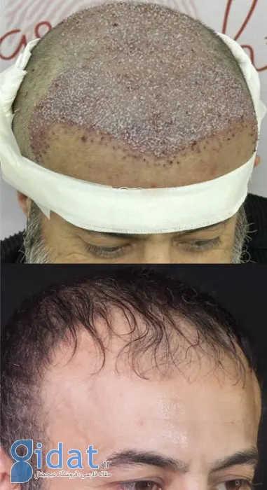 طبیعی بودن خط رویش مو در کاشت مو