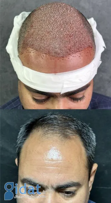 کاشت مو طبیعی