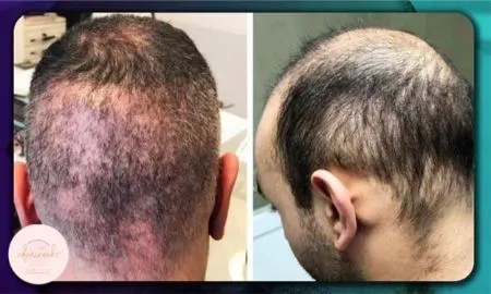 نشان ‌های کاشت مو ناموفق