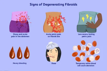 ترکیدگی فیبروم رحمی؛ عوارض، علل و راههای پیشگیری