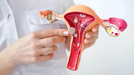 ترکیدن فیبروم رحم, عوارض فیبروم رحمی