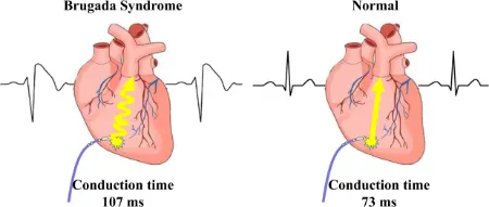 سندرم بروگادا: یک آریتمی قلبی که می تواند کشنده باشد