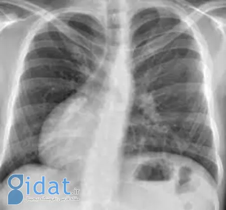 دکستروکاردیا, علائم دکستروکاردیا