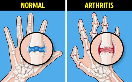  درمان درد مفاصل, درد مفاصل انگشتان دست