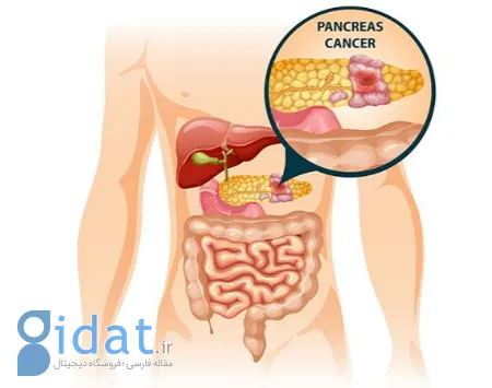 رژیم غذایی سرطان پانکراس, رژیم غذایی بیماران سرطان پانکراس