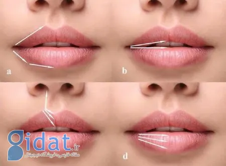 مدل طبیعی تزریق ژل لب