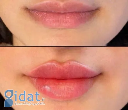 تزریق ژل لب برای حجم‌دهی