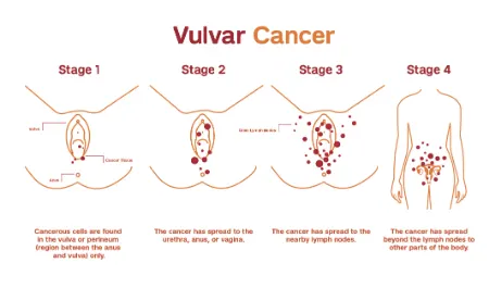 سرطان ولو, مراحل سرطان ولوو