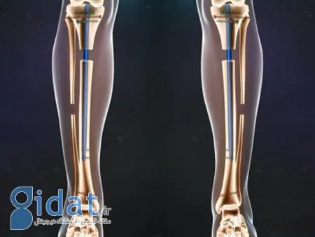 عوارض جراحی افزایش قد, عوارض عمل افزایش قد, عمل افزایش قد
