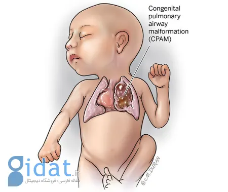 ناهنجاری مادرزادی ریه, ناهنجاری مادرزادی ریه در بزرگسالان