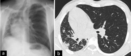 ناهنجاری مادرزادی ریه, ناهنجاری مادرزادی ریه در بزرگسالان
