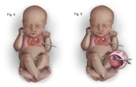 ناهنجاری مادرزادی ریه, ناهنجاری مادرزادی ریه در بزرگسالان