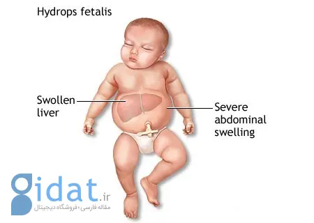 هیدروپس جنین: تشخیص و درمان در بارداری