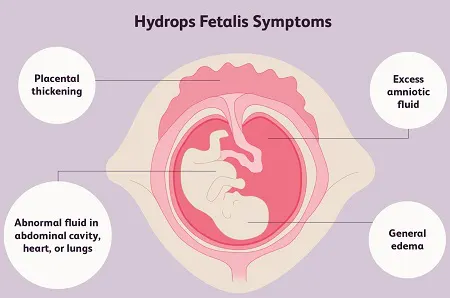 هیدروپس جنینی, علائم هیدروپس جنینی, انواع هیدروپس جنینی