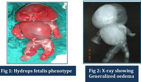 هیدروپس جنینی, علائم هیدروپس جنینی, جنین با مشکل هیدروپس جنینی