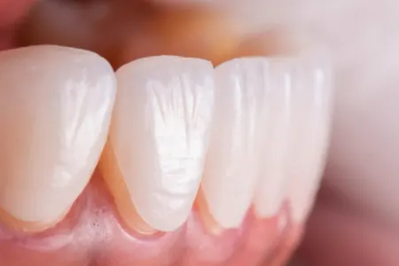 ماندگاری و دوام لمینت دندان, مراقبت از لمینت دندان