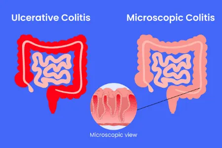 کولیت میکروسکوپی چیست؟ علائم، علل و درمان موثر