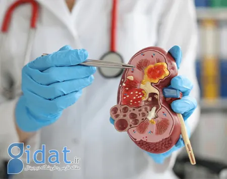 نفرولیتوتومی از راه پوست, بهبودی پس از PCNL