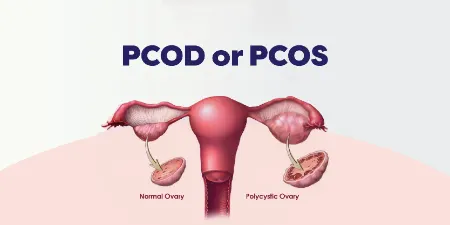 تفاوت pcod و pcos, pcos چيست