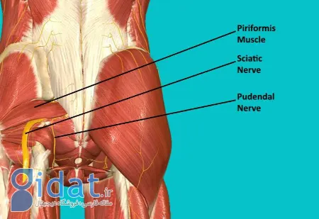تسکین درد مزمن کف لگن؛ داستان واقعی بهبودی از نورالژی پودندال
