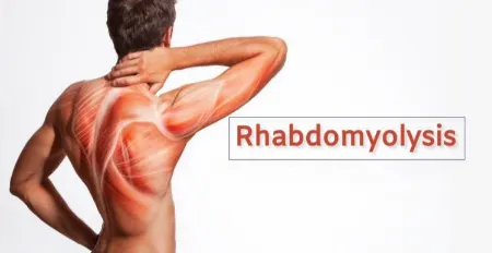 رابدومیولیز چیست, علائم رابدومیولیز