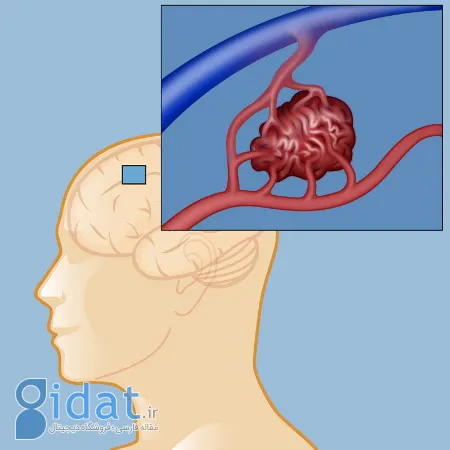 avm مغزی, بیماری avm مغزی