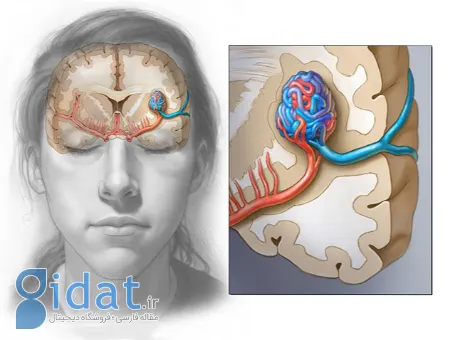 avm مغزی, بیماری avm مغزی
