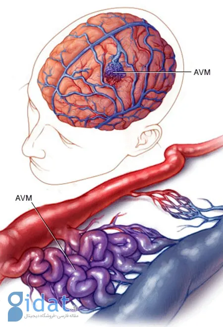 avm مغزی, بیماری avm مغزی
