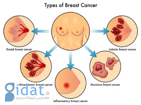 تفاوت بین جوش سینه و سرطان سینه, جوش سينه زنان