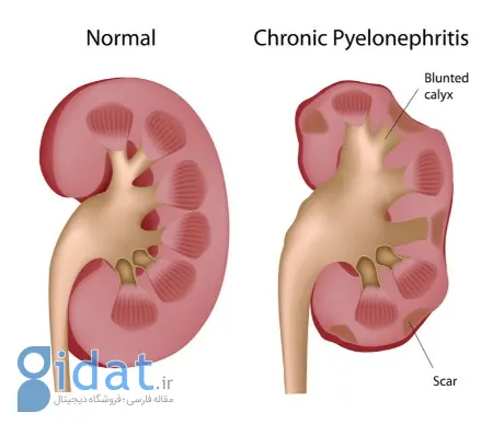 استاز کلیه, عفونت ادراری