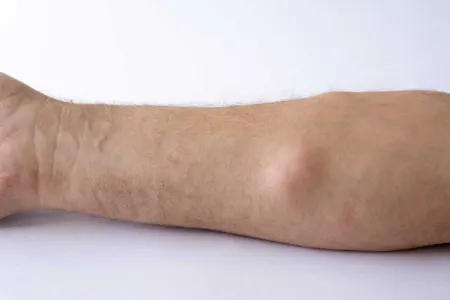 لیپوسارکوما در یک نگاه؛ هر آنچه باید درباره این سرطان بدانید