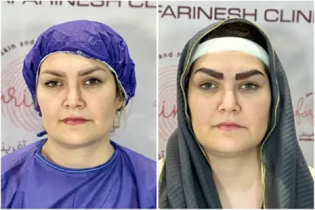 تفاوت بین میکروکاشت و کاشت ابرو چیست؟ مقایسه کامل از هزینه تا دوام