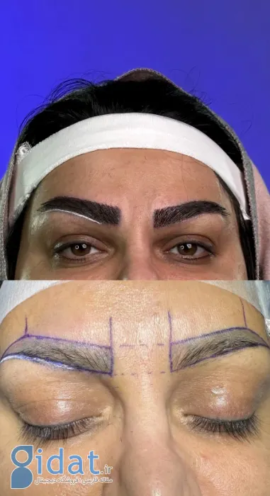 کاشت ابرو چیست؟