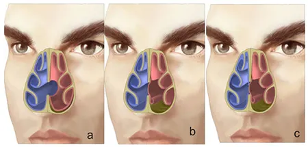 سوراخ شدن تیغه بینی, سوراخ شدن تیغه بینی بعد از عمل, سوراخ‌های کوچک ممکن است علامتی نداشته باشند