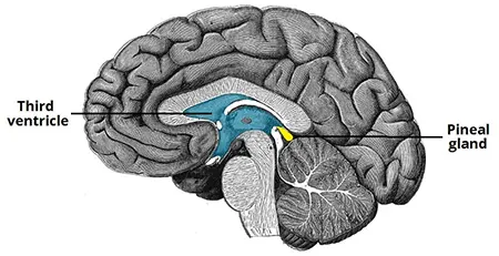 غده صنوبری, پاکسازی غده صنوبری, بیماریهای غده صنوبری