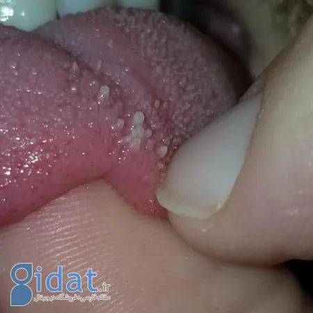 علت تورم جوانه‌های چشایی, پاپیلیت زبانی گذرا
