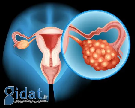 علائم سرطان تخمدان و راه های درمان آن