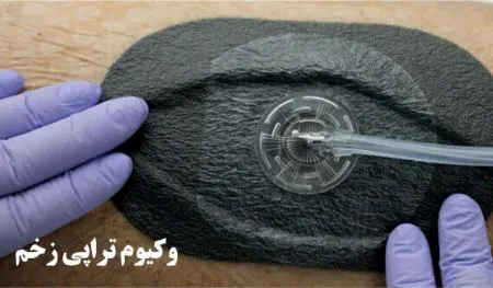 وکیوم تراپی زخم عفونی