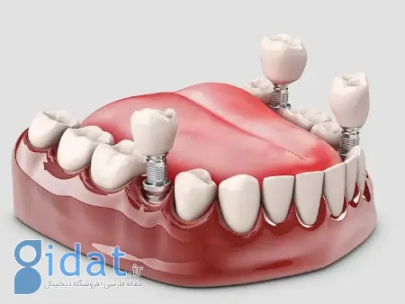 مراحل دقیق انجام ایمپلنت فوری در تهران