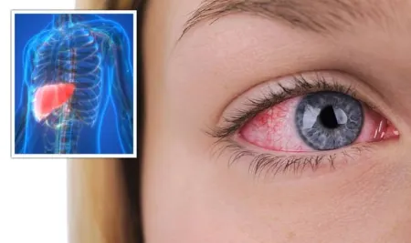 اگر چشمان شما این شکلی است، کبد شما در معرض خطر است