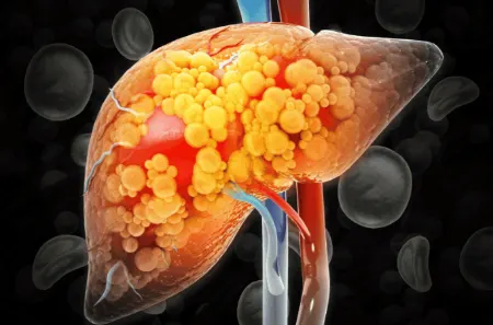 علائم کبد چرب در چشم, درمان کبد چرب با طب سنتی