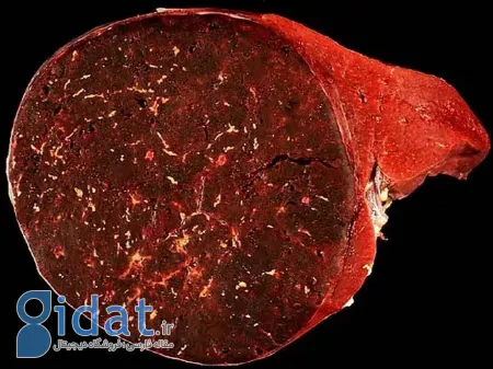 هامارتوما, تومور خوش خیم ریه