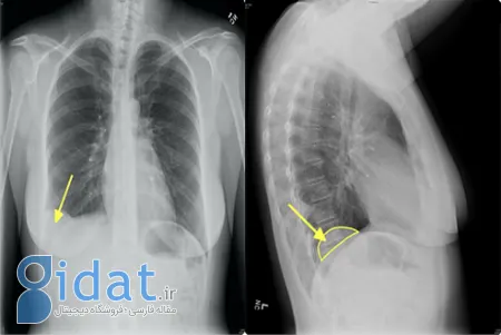 هامارتوما, تومور خوش خیم ریه